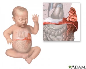 an illustration of a baby and a close up image of a baby's diaphragm with a congenital diaphragmatic hernia 