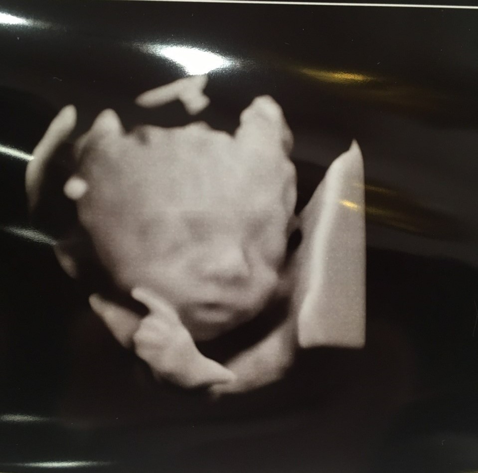 Rebecca's ultrasound