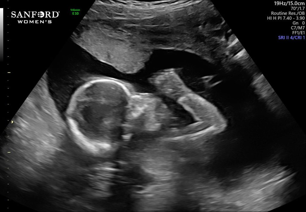 Stella's ultrasound